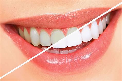 Experience the Magic of Lifelike Tooth Whitening